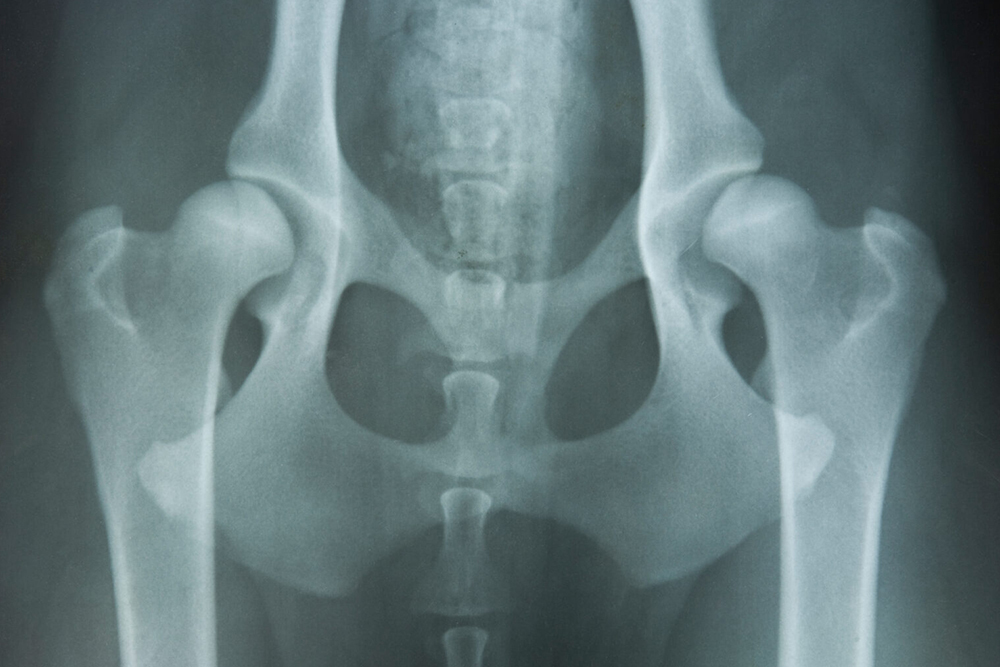 W-Ray to diagnose spinal injury in Orlando Florida